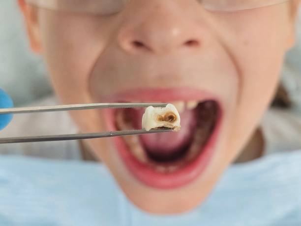 Urgent Tooth Repair in UT